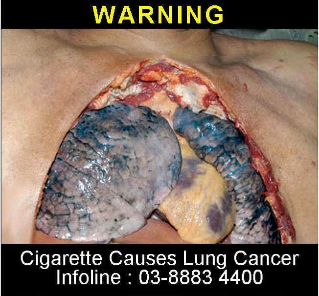 Malaysia 2008 Health Effects Lung - Lung cancer, open chest (back)